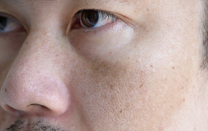Cuidados com o melasma no verão: como proteger a pele na estação mais quente