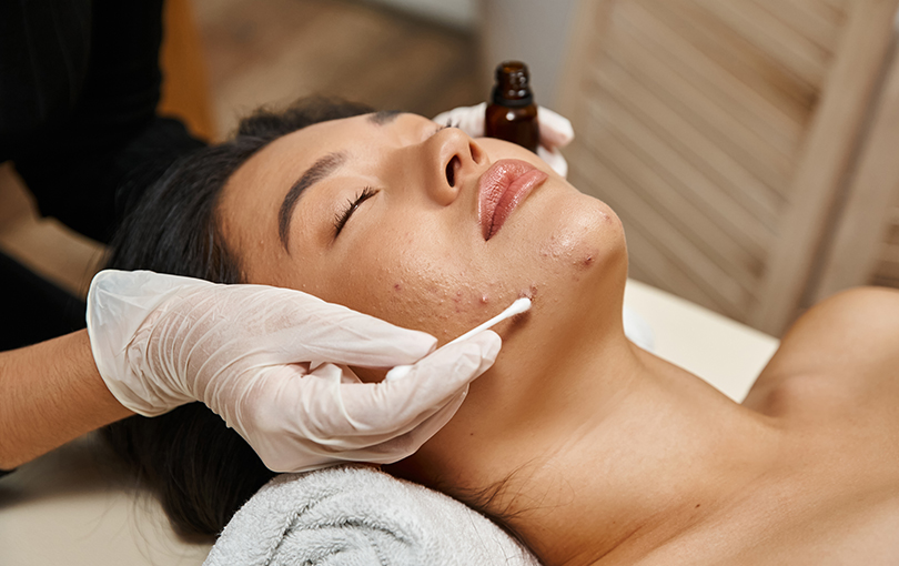 Tratamentos profissionais para acne em Itajaí: o que funciona de verdade?